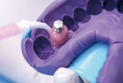 GumEasy™ A – Silicone for Gingival Mask:  Where Accuracy Meets Esthetics in Implant Restorations